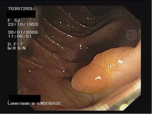 Endoscopia