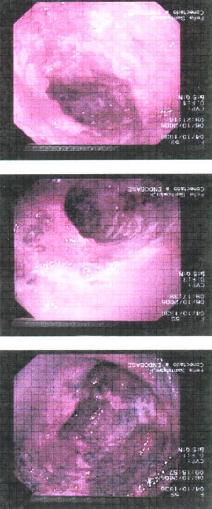 Endoscopia